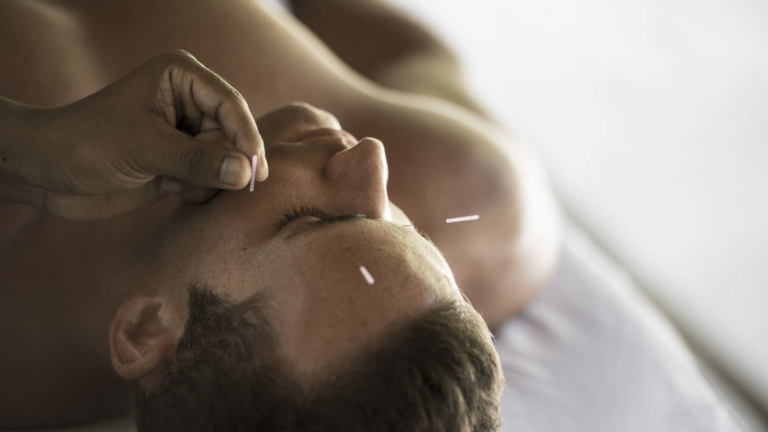Close up of a man's face as he receives an acupuncture treatment