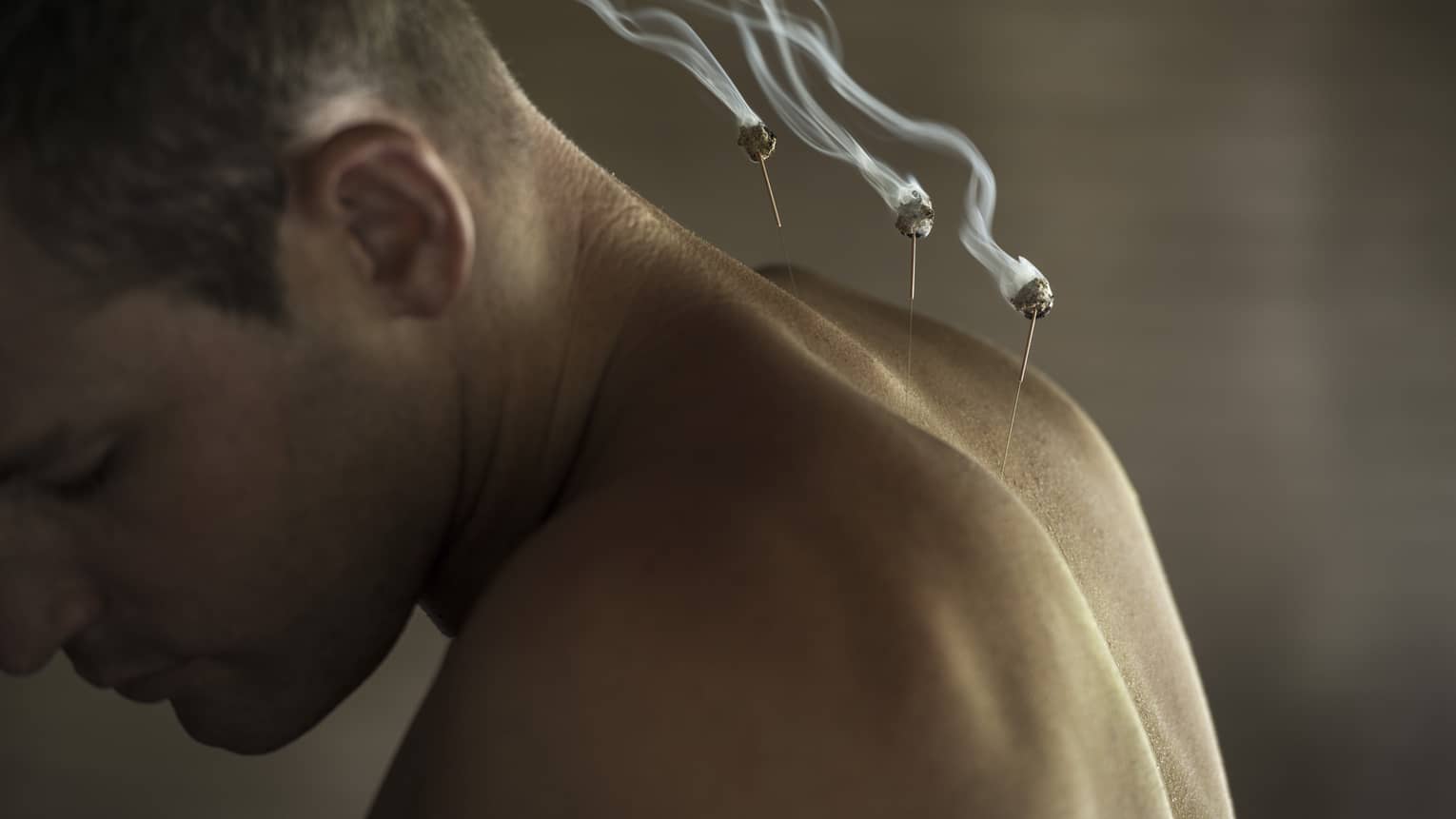 Closeup of man's shoulders as he undergoes acupuncture