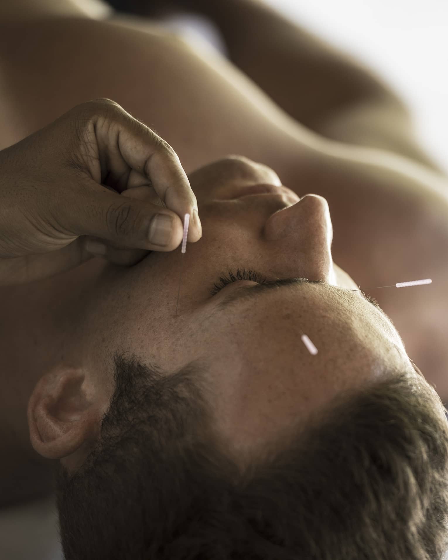 Close up of a man's face as he receives an acupuncture treatment