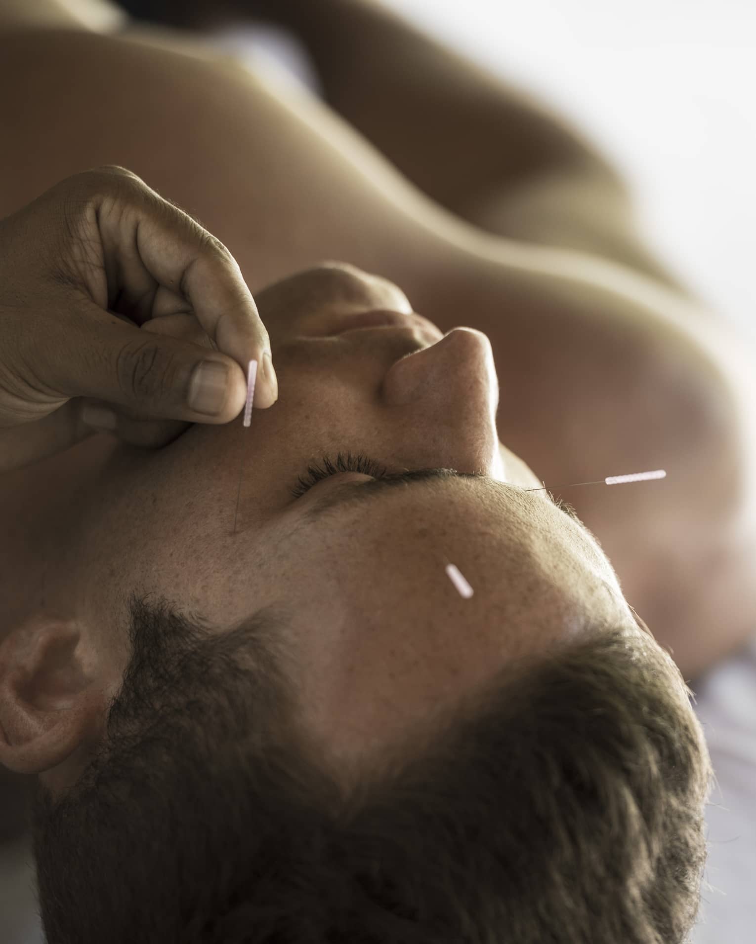 Close up of a man's face as he receives an acupuncture treatment
