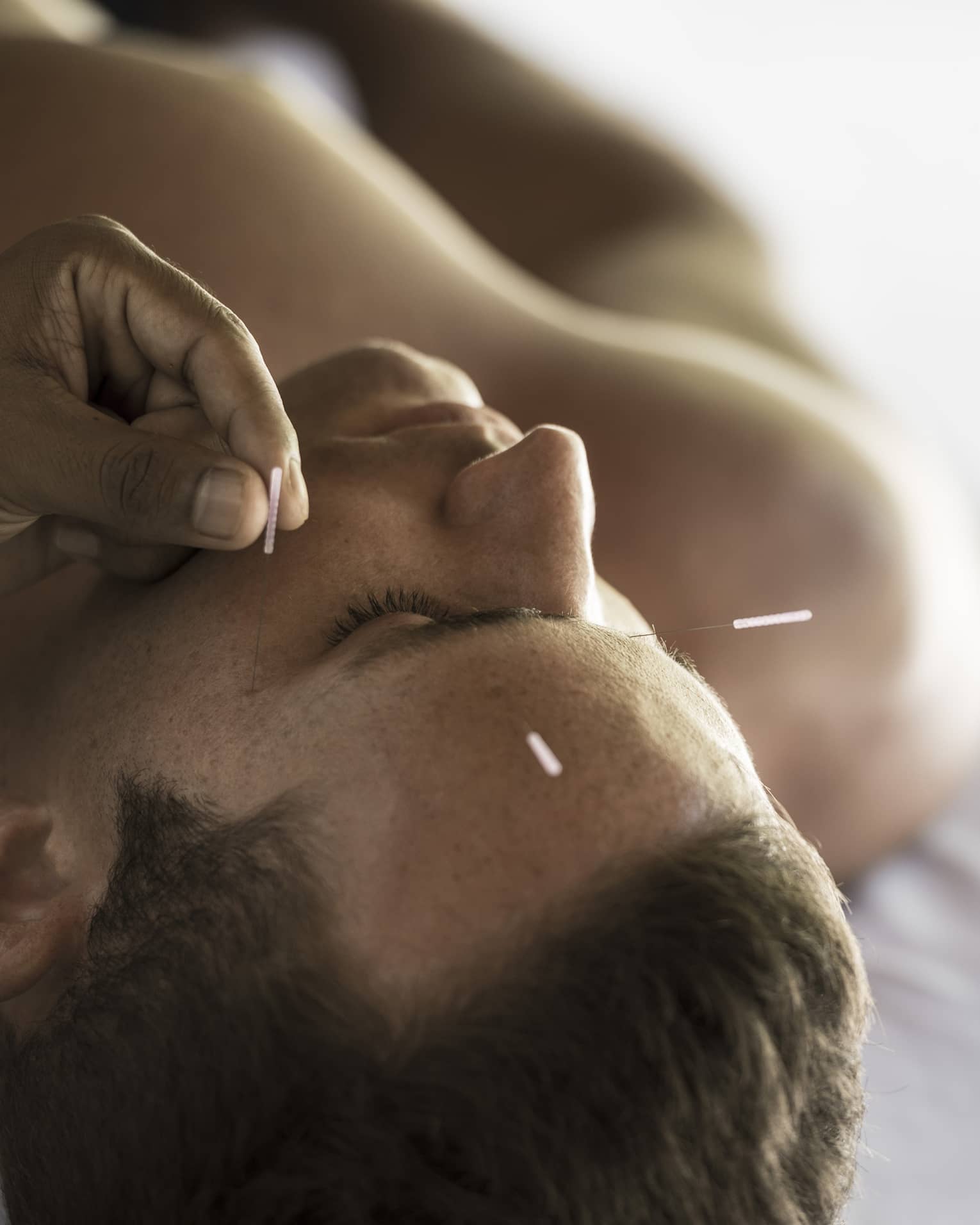 Close up of a man's face as he receives an acupuncture treatment