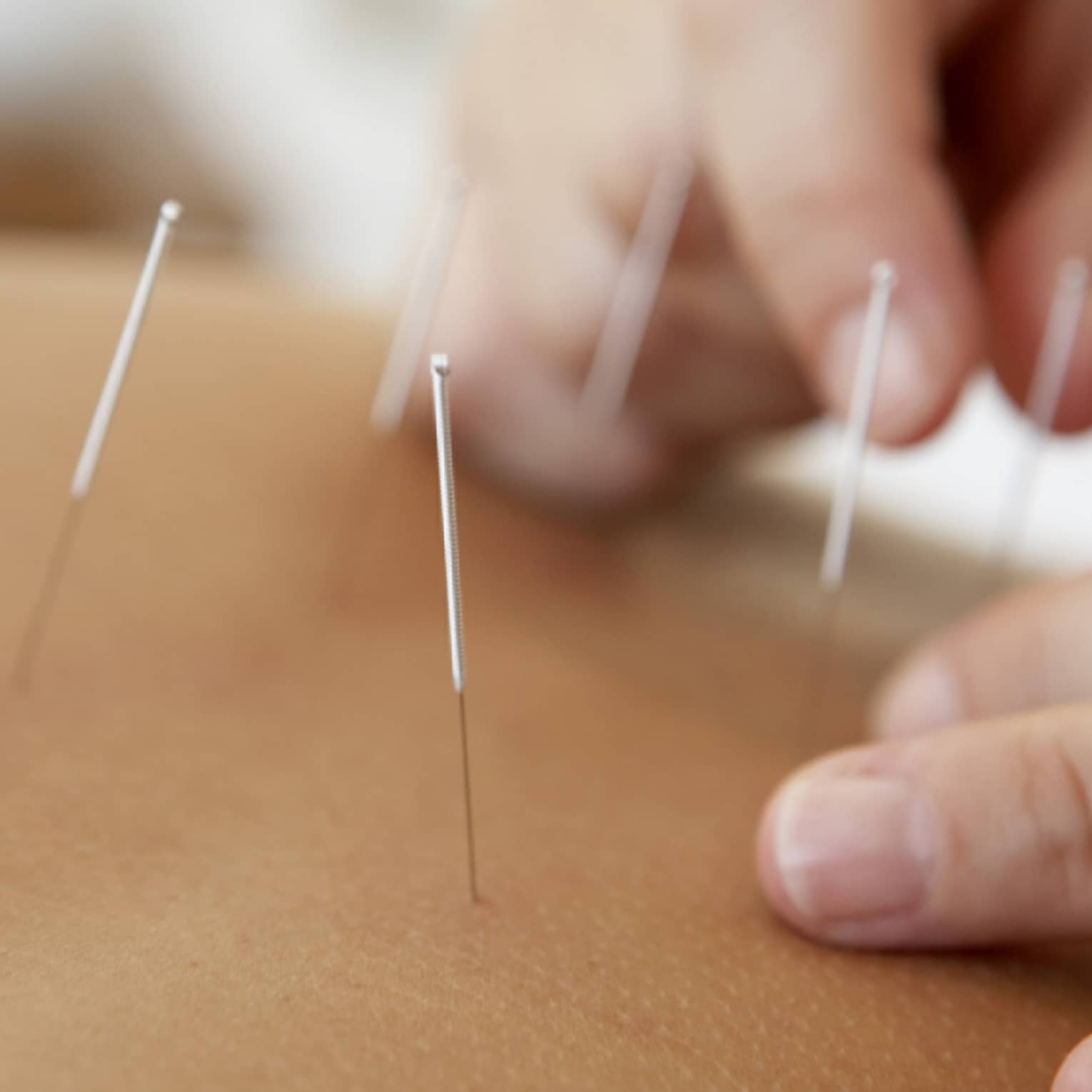 Close up of acupuncture procedure