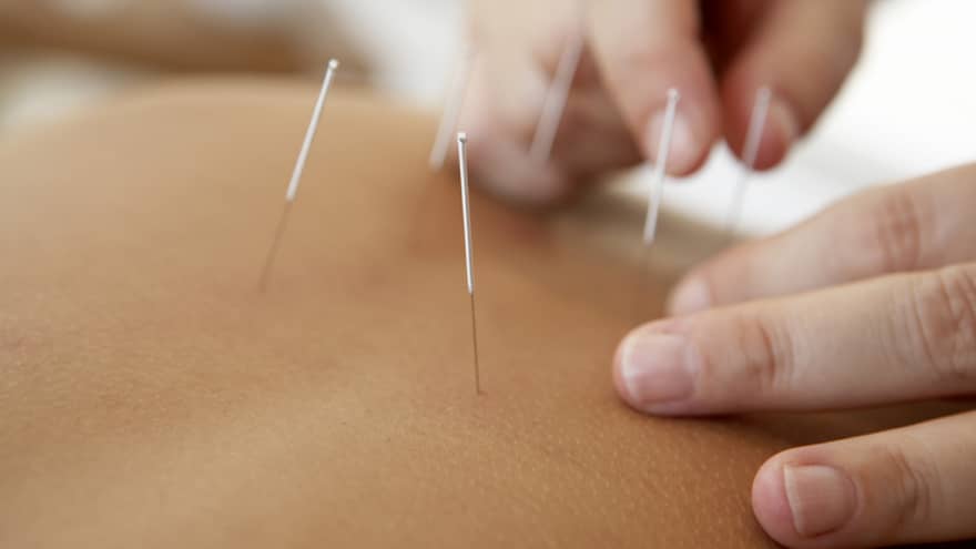 Close up of acupuncture procedure