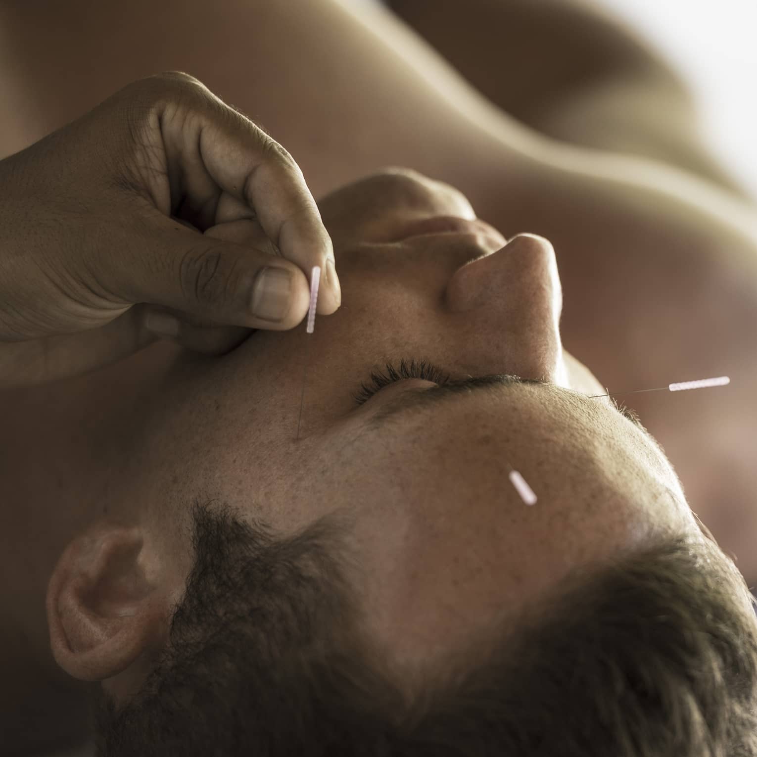 Close up of a man's face as he receives an acupuncture treatment